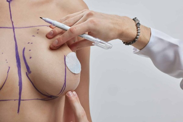 Tout savoir sur la chirurgie esthétique des seins